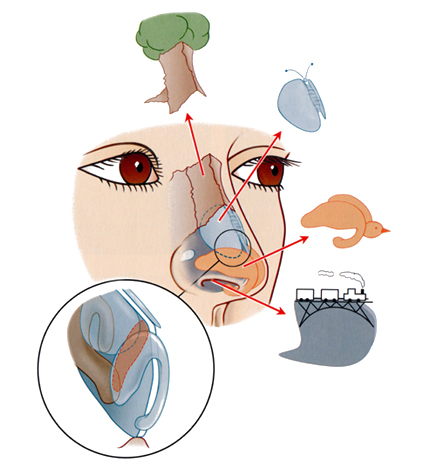 Chirurgia plastyczna nosa